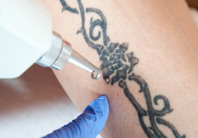 Tattoo weg laten halen door de specialist van Nederland!